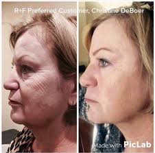 There are several tightening and rejuvenating procedures that might help, but it really depends on each less invasive procedures involve the use of professional medical microdermabrasion (mda) which is a resurfacing technique that uses a stream of fine. How To Fix Crepey Skin