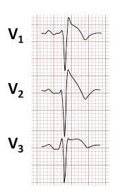 Brugada Syndrome Wikipedia