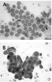 It usually occurs from prior exposure to asbestos, a type of mineral fiber used in the insulation industry. Cytology Of The Canine Mesothelioma Peritoneal Effusion A Note The Download Scientific Diagram
