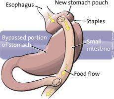Malabsorptive Bariatric Surgery Google Search Bariatric Surgery Sleeve Bariatric Surgery Bariatric