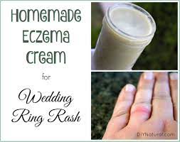 Wedding Ring Rash A Homemade Cream That Relieves And Heals Eczema Cream Wedding Ring Rash Psoriasis Treatment Cream