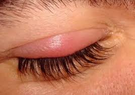 Arpacik Nasil Gecer Eye Stye Remedies Blepharitis Dry Skin Remedies