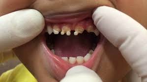 We did not find results for: Sugary Drinks And Junk Food Blamed As Kids Have Rotten Baby Teeth Pulled Out Stuff Co Nz