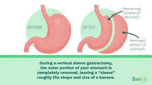If it's a real concern for you, see your. Can Liquids Stretch Your Stomach After Gastric Sleeve Surgery