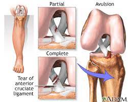 The acl (anterior cruciate ligament) is a band of tissue inside your knee. Anterior Cruciate Ligament Acl Injury Medlineplus Medical Encyclopedia