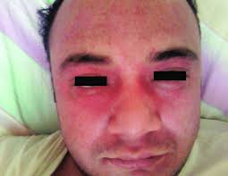 Numerous petechiae with redness and edema