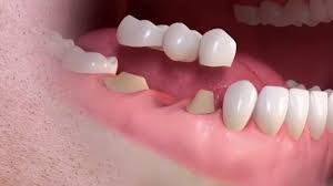 Gigi palsu, crown gigi, implan atau gigi tiruan merupakan layanan global estetik dental care untuk mengembalikan fungsi gigi dalam kehidupan seperti untuk berbicara lebih nyaman dan makan lebih. Biaya Gigi Tiruan Jembatan Terbaru Biaya Info