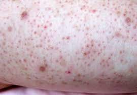 Laser hair removal is used to reduce unwanted hair. What Are Those Bumps On Your Arms And How Can You Get Rid Of Them Health Essentials From Cleveland Clinic