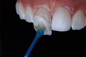 Dental veneers are thin pieces of porcelain that are custom made for each individual patient; How Have Dental Veneers Changed Over Time Pathway Dentists