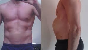 Maybe you would like to learn more about one of these? 6 169lb Male With Diastasis Recti Considering Corrective Surgery And Would Appreciate Advice Photo