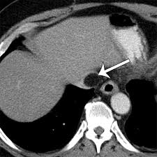 El libertino invisible, libertino invisible, el libertino invisible descargar, libertino invisible descargar, el guardian invisible pdf, pdf la frontera invisible, testigo invisible pdf. Multimodality Imaging Of Abdominopelvic Tumors With Venous Invasion Radiographics