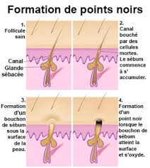 En plus de nettoyer et détoxifier la peau profondeur la peau, ils. Points Noirs Enlever Les Points Noirs Symptomes Traitement Definition Docteurclic Com