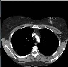 It feels like about an inch around, like the size of a big marble. Breast Carcinoma On Ct Chest Radiology Case Radiopaedia Org