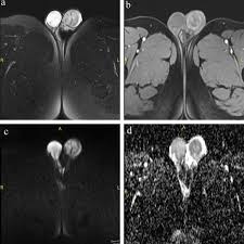 Cystic ectasia of the rete testis must be differentiated from other benign intratesticular lesions, notably cystic dysplasia and intratesticular varicocele. Value Of Diffusion Weighted Magnetic Resonance Imaging In Diagnosis And Characterization Of Scrotal Abnormalities Sciencedirect