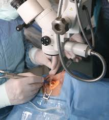 Icon Bioscience Releases Positive Data On Phase 3 Study For Eye Surgery Cataract Surgery Medical Photos