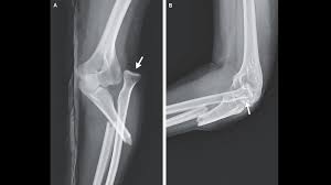 Image result for Radial Head Dislocation