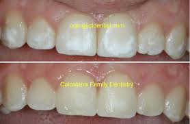This fragile area results from a process called hypocalcification, which some patients choose to wait until their next routine exam and teeth cleaning, whereas others make an extra appointment to determine how to strengthen. White Stains On Teeth After Braces Teethwalls
