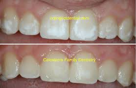 It involves a simple chemical treatment with one of two teeth bleaching agents: White Spots On Teeth Teethwalls