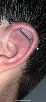 My Industrial Is Having A Real Issue With Keloids 4 Months In Cleaning 2 Times A Day I Ve Tried Tea Tree Oil For About 2 Weeks And It Hasn T Helped Any Ideas