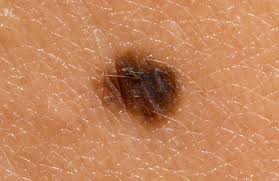 If breast cancer is diagnosed at an early enough stage, it's treatable. Penile Cancer Causes Symptoms And Treatment