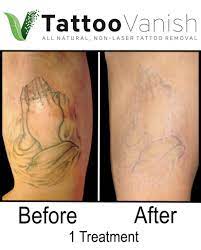 Photos are from real customers at q esthetics, but similar results are not guaranteed. Before And After Tattoo Removal Get The Best Results The All Natural Way Tattoo Removal Pictures Tattoo Vanish