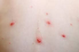 Treatment can be given at home to ease symptoms. Chickenpox Symptoms Treatment Stages And Causes
