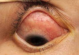 Idiopathic Orbital Inflammation Other Eye Conditions The Eyes Have It