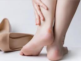 Rộp da: Nguyên nhân, cách xử trí và phương pháp phòng ngừa