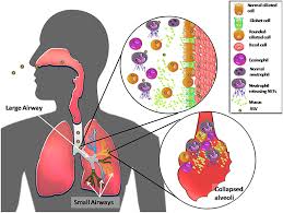 Respiratory syncytial virus (rsv) is a highly contagious, seasonal lung infection. Frontiers Host Components Contributing To Respiratory Syncytial Virus Pathogenesis Immunology