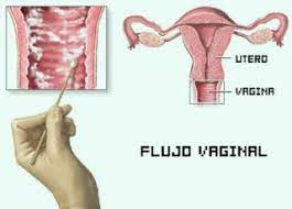 Flujo Vaginal