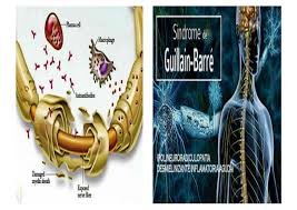 Fecha, 7 de febrero de 2016. Sindrome De Guillain Barre By Eduardo Diaz Beltran Issuu