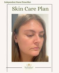 Real Results ✨ My lovely client had been struggling with persistent acne  and decided it was time for a real change. These are the amazing results  after 3 months of a consistent