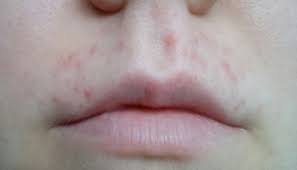 Top Lip Waxing Nightmare With Pic Mumsnet