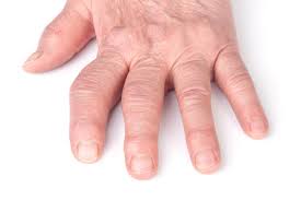 Steife Finger Ursachen Behandlung Vorbeugung Gesundpedia De