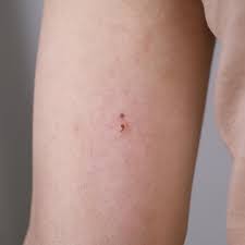 Birthmark On Leg Meaning Tattoo Idea With Birthmark By Tattooist Arar Funny Gifs Viralvids Funnypics Cute More At Http Www Theviralmonst Minimalist Tattoo Tattoos Eye Tattoo
