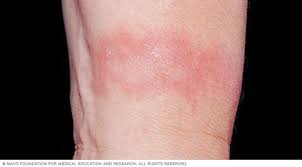 Image result for dermatitis contacta