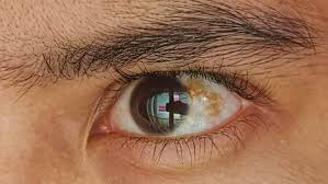 Image result for melanosis sclera