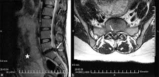 Mri of marked dural sac compression by surgical in the immediately postoperative period after uncomplicated lumbar laminectomy.// lumbar cauda equina syndrome associated with the use of gelfoam: Lumbar Disk Herniation Presented With Cauda Equina Syndrome In A Pregnant Woman Abstract Europe Pmc
