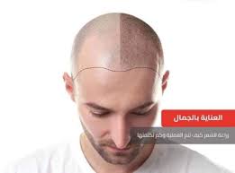 زراعه الشعر والتجميل بدون جراحة كاش و بالتقسيط home facebook