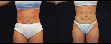 Six Pack Abs Before And After Photos Baltimore Plastic Surgery Gallery Columbia Dr Daniel Markmann