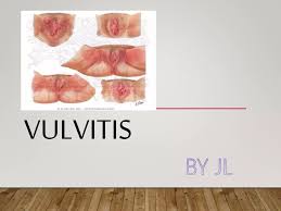 Image result for Vulvitis