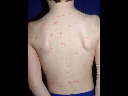 Image result for chickenpox
