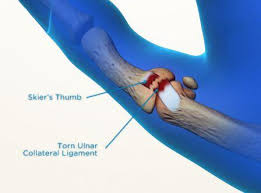 This type of acl injury is often referred to as a partial tear of the ligament. Ulnar Collateral Ligament Injury Of Thumb Mcp Joint Melbourne Hand Surgery