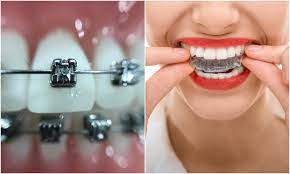The more you do for your teeth when you have braces, the less you have to do afterwards. Can You Whiten Teeth With Braces Or Invisalign
