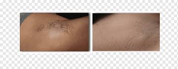 Costs tend to be cheaper than laser hair removal, and practised more widely common areas are the upper lip, chin, jawline, sideburns, armpits, forearms, tummy, bikini line / brazilian, legs, feet and toes. Wrinkle Close Up Shaving Fn Scar Dog Grooming Laser Hair Removal Lip Shaving Chin Png Pngwing