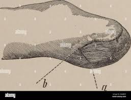 St Louis Courier Of Medicine Fig 3 King Practical Points In Railroad Surgery 39 Impossible We Made Amputations In Both At Different Times Both Operations Being Done By My First House Surgeou