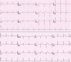 Nstemi treatment treatment will depend on the amount of blockage. Accuracy Of Omi Ecg Findings Versus Stemi Criteria For Diagnosis Of Acute Coronary Occlusion Myocardial Infarction Sciencedirect