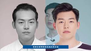 男性植髮】前額植髮手術- 韓國歐巴Yoontae Kim的手術經驗談