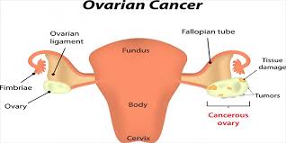 • prevent cervical cancer by detecting and treating true cancer precursors. Ovarian Cancer Symptoms 10 Early Warning Signs You Need To Know Seereadshare