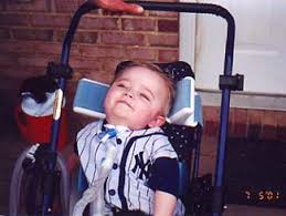Barre syndrome as a cause of acute flaccid. Sindrome De Guillain Barre En Ninos Guia De La Discapacidad